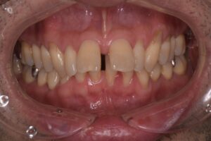 治療前（写真1）