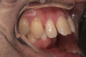 治療前（写真2）