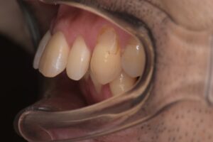 治療前（写真3）