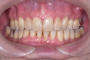 治療後（写真1）