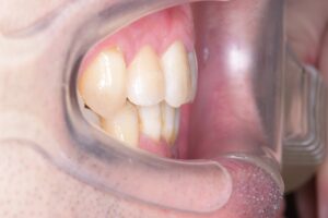 治療後（写真2）