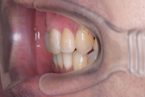 治療後（写真3）