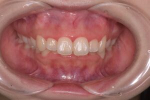 治療前（写真1）