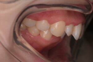 治療前（写真2）