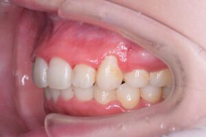 治療後（写真3）