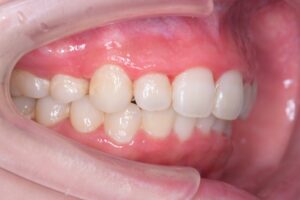 治療後（写真2）