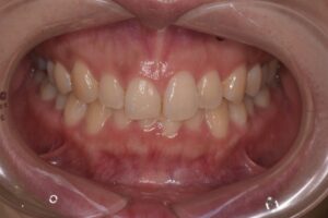 治療前（写真2）