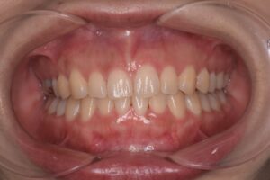 治療後（写真2）