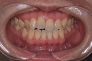 治療前（写真1）