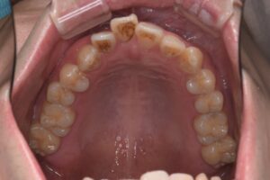 治療前（写真2）