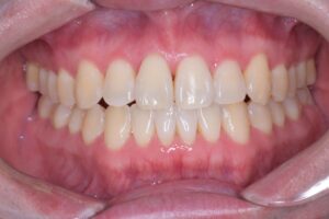 治療後（写真1）