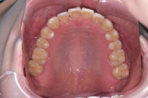 治療後（写真2）