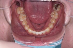 治療後（写真3）