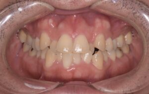 治療前（写真1）