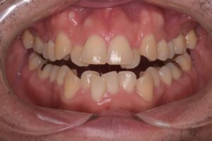 治療前（写真2）