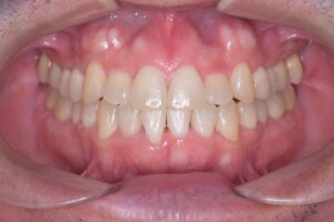 治療後（写真1）