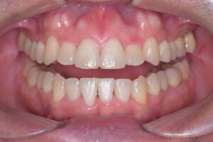 治療後（写真2）