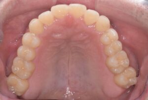 治療後（写真3）