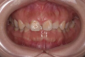 治療前（写真1）