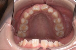 治療前（写真2）