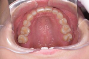 治療後（写真2）