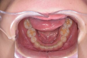 治療後（写真3）