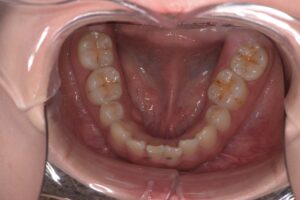 治療前（写真3）