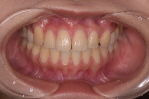 治療前（写真1）