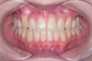 治療後（写真1）