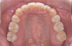 治療後（写真2）