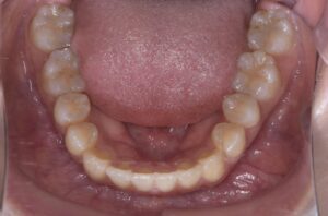 治療後（写真3）