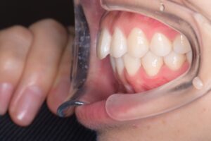 治療後（写真2）