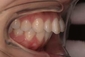 治療前（写真1）