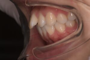 治療前（写真2）