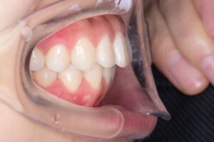 治療後（写真1）