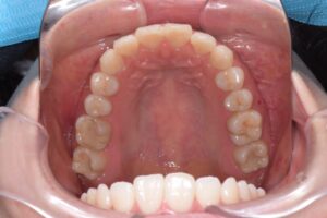 治療後（写真3）