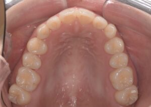 治療後（写真2）