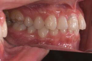 治療前（写真1）