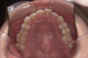 治療前（写真2）