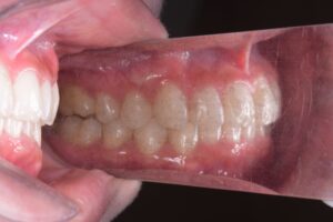 治療後（写真1）