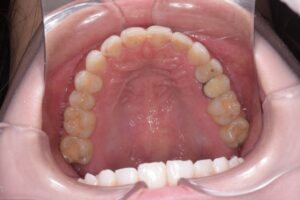 治療後（写真2）