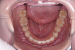 治療後（写真3）