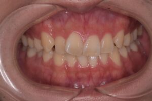 治療前（写真1）