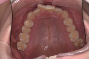 治療前（写真2）