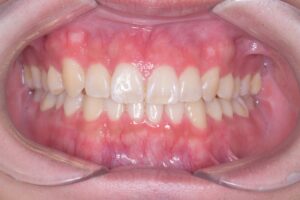 治療後（写真1）