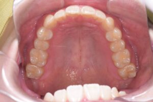 治療後（写真2）