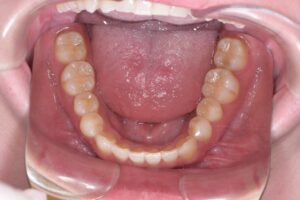 治療後（写真3）