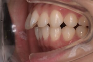 治療前（写真1）