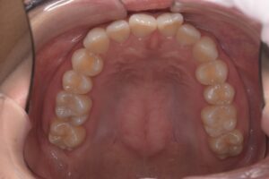 治療前（写真2）