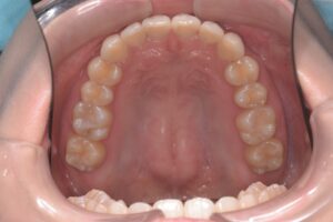 治療後（写真2）